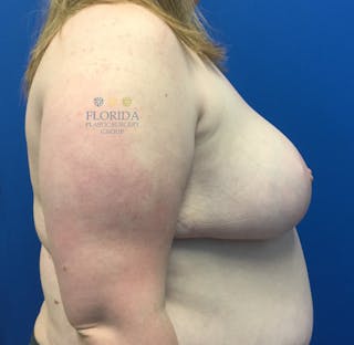 Breast Reduction Before & After Gallery - Patient 154952211 - Image 4