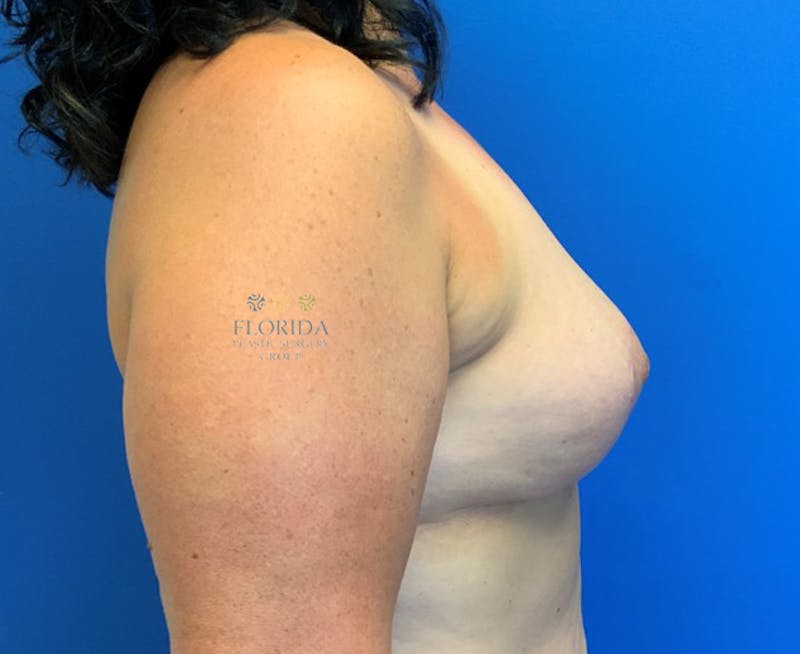 Revision Breast Surgery Before & After Gallery - Patient 154952212 - Image 6