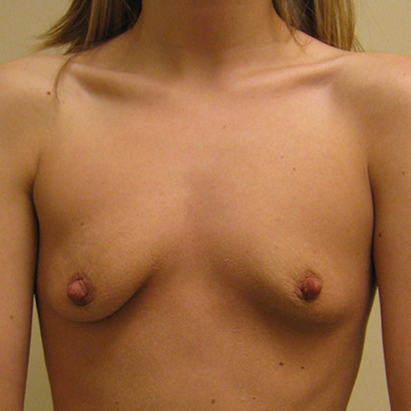 Silicone Breast Augmentation Before & After Gallery - Patient 154952217 - Image 1