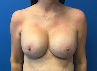 Revision Breast Surgery Before & After Gallery - Patient 154952219 - Image 2