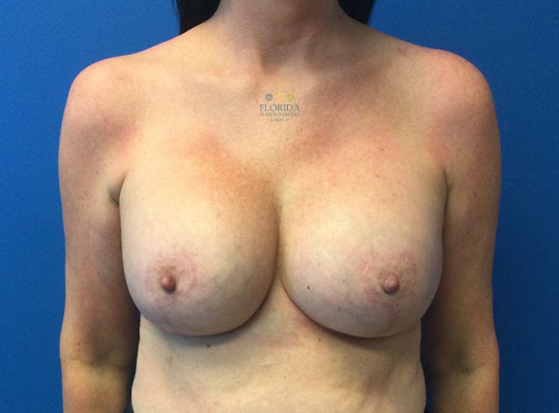 Revision Breast Surgery Before & After Gallery - Patient 154952219 - Image 2