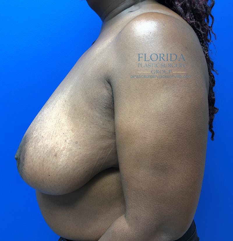 Breast Reduction Before & After Gallery - Patient 154952218 - Image 3