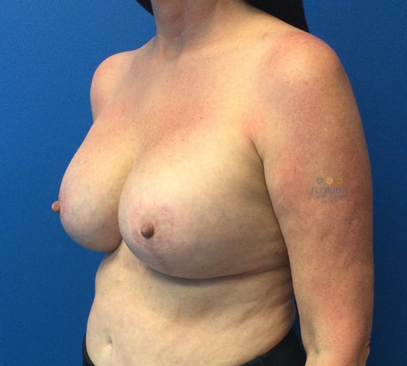 Revision Breast Surgery Before & After Gallery - Patient 154952219 - Image 4
