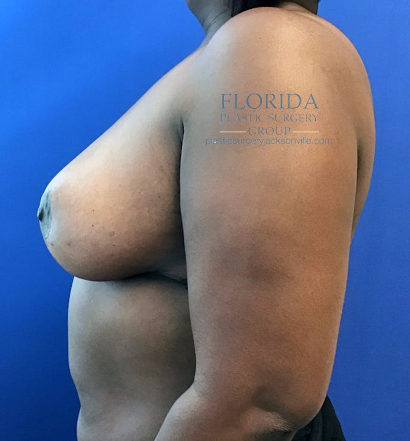 Breast Reduction Before & After Gallery - Patient 154952218 - Image 4