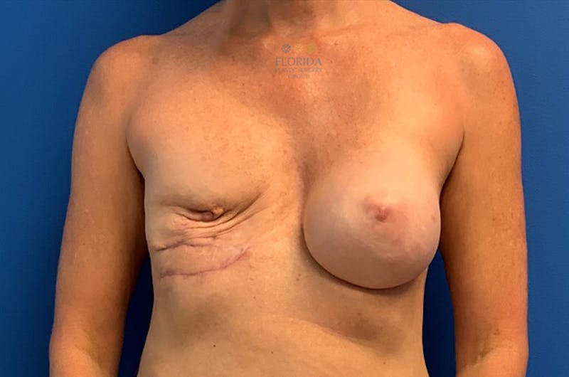 Tissue Expander Reconstruction Before & After Gallery - Patient 154952223 - Image 1