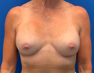 Revision Breast Surgery Before & After Gallery - Patient 154952224 - Image 2