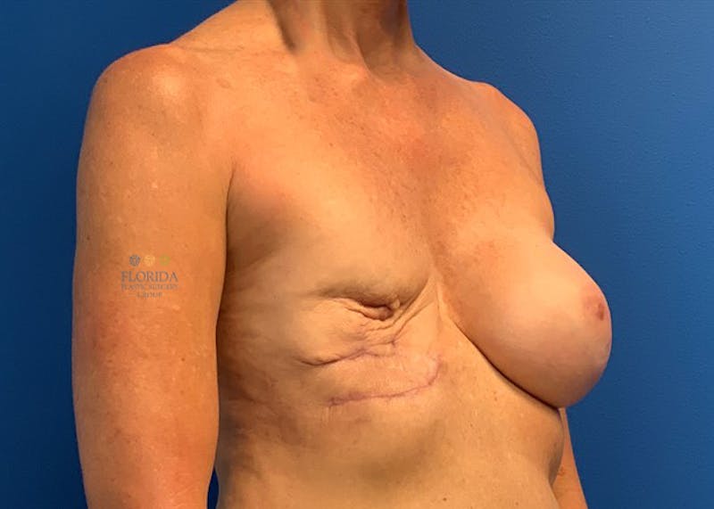 Tissue Expander Reconstruction Before & After Gallery - Patient 154952223 - Image 3