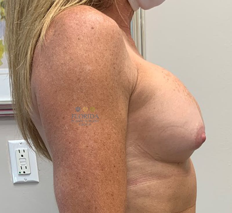 Revision Breast Surgery Before & After Gallery - Patient 154952224 - Image 3