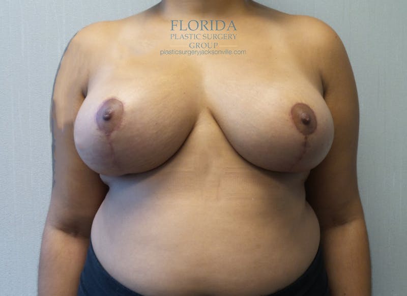Breast Reduction Before & After Gallery - Patient 154952228 - Image 2
