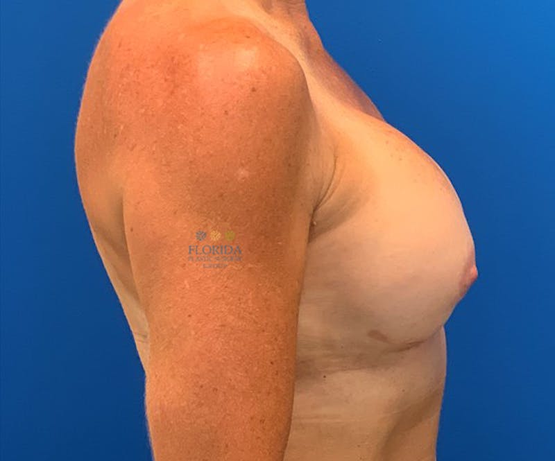 Revision Breast Surgery Before & After Gallery - Patient 154952224 - Image 4