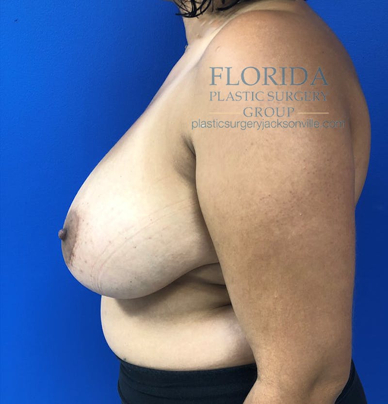 Breast Reduction Before & After Gallery - Patient 154952228 - Image 5