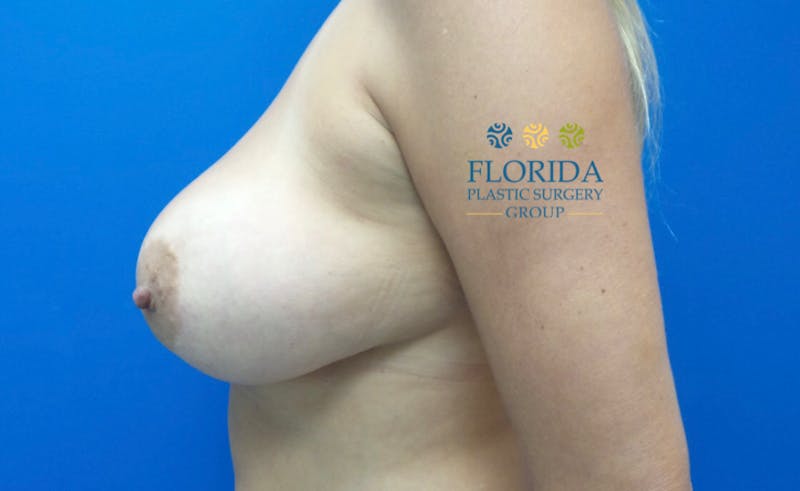 Revision Breast Surgery Before & After Gallery - Patient 154952229 - Image 3