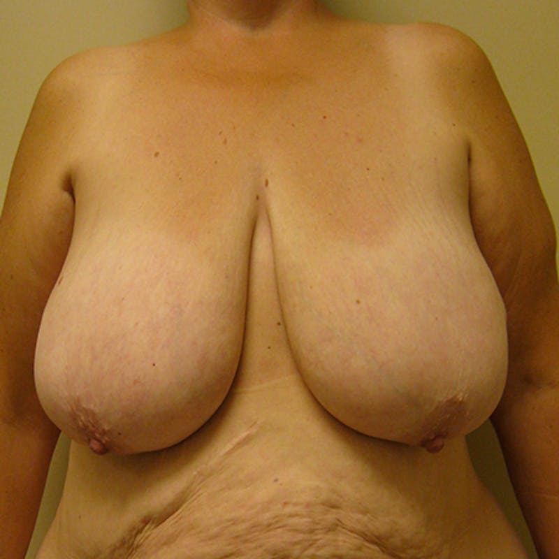 Breast Reduction Before & After Gallery - Patient 154952232 - Image 1