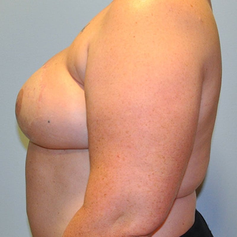 DIEP Flap Reconstruction Before & After Gallery - Patient 154952231 - Image 6