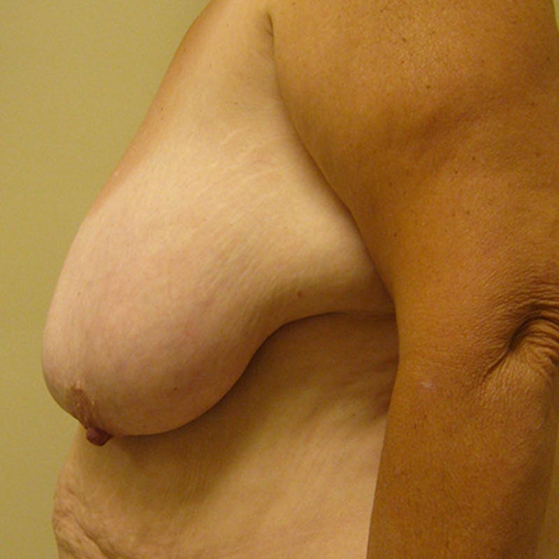 Breast Reduction Before & After Gallery - Patient 154952232 - Image 3