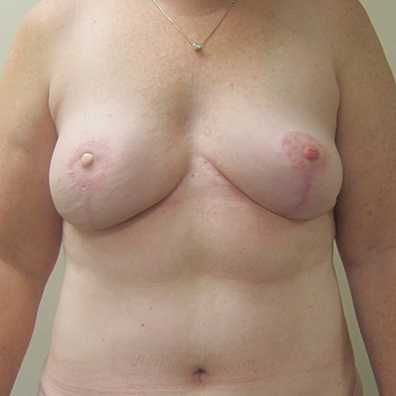 DIEP Flap Reconstruction Before & After Gallery - Patient 154952295 - Image 2