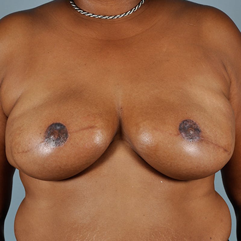 Tissue Expander Reconstruction Before & After Gallery - Patient 154952296 - Image 2