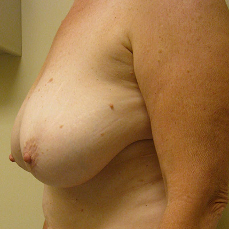Breast Reduction Before & After Gallery - Patient 154952293 - Image 3