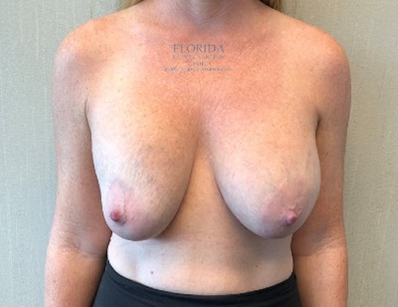 Revision Breast Surgery Before & After Gallery - Patient 154952292 - Image 1