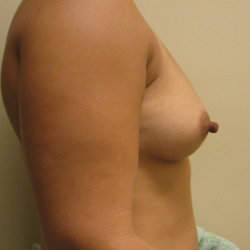 Silicone Breast Augmentation Before & After Gallery - Patient 154952294 - Image 5