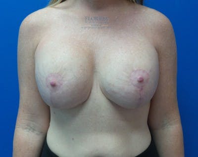 Revision Breast Surgery Before & After Gallery - Patient 154952292 - Image 2