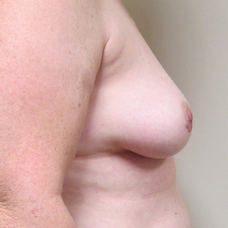 DIEP Flap Reconstruction Before & After Gallery - Patient 154952295 - Image 5