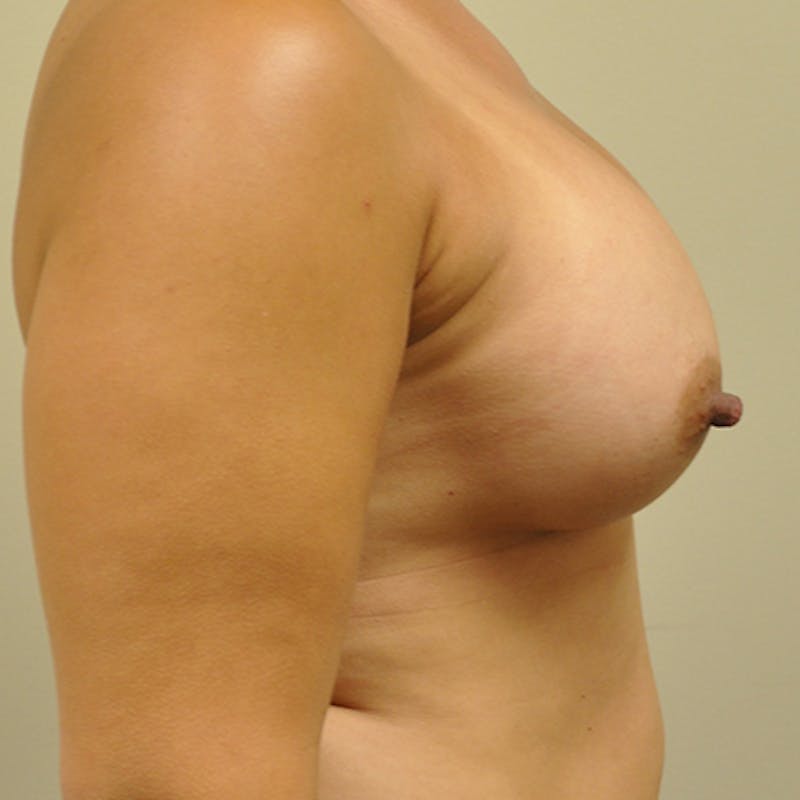 Silicone Breast Augmentation Before & After Gallery - Patient 154952294 - Image 6