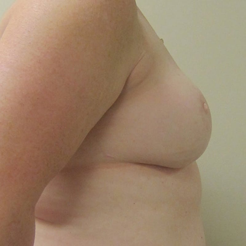 DIEP Flap Reconstruction Before & After Gallery - Patient 154952295 - Image 6