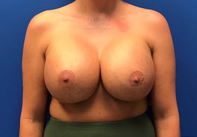 Revision Breast Surgery Before & After Gallery - Patient 154952297 - Image 2
