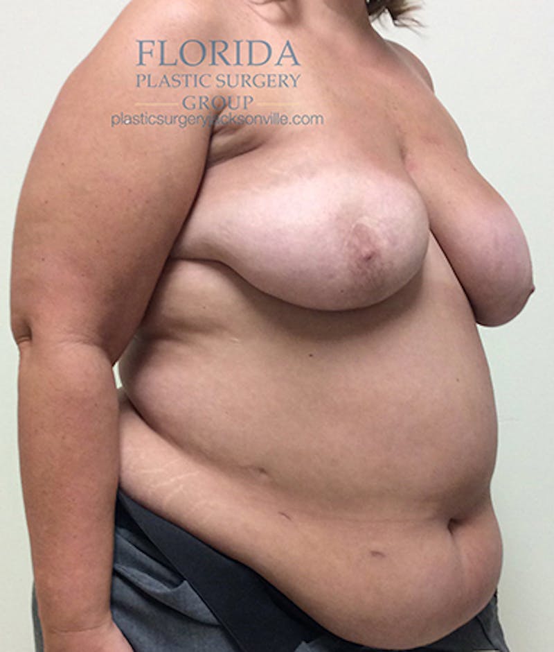 DIEP Flap Reconstruction Before & After Gallery - Patient 154952303 - Image 3