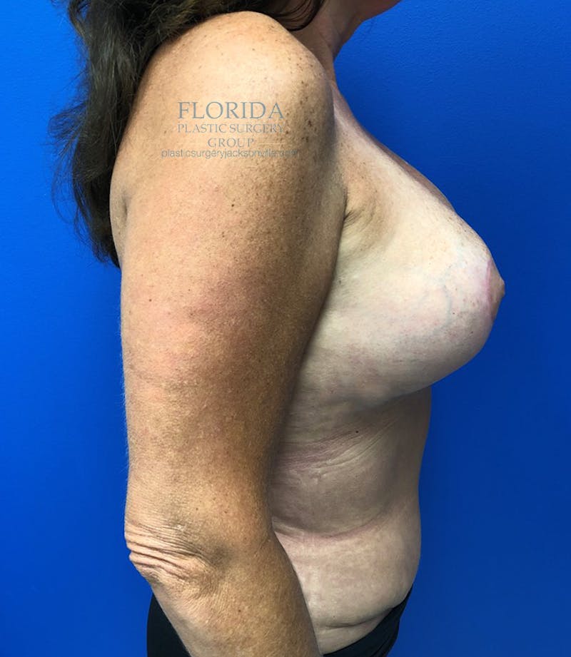 Revision Breast Surgery Before & After Gallery - Patient 154952301 - Image 4