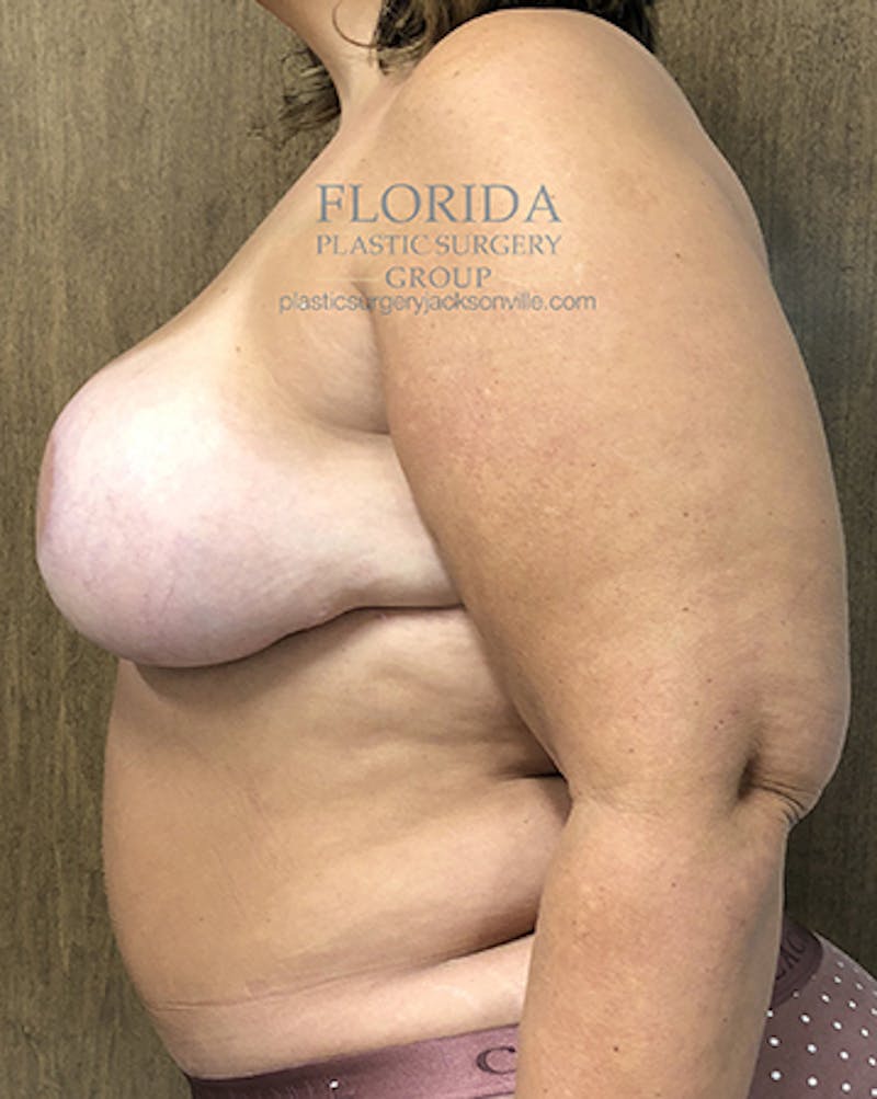 DIEP Flap Reconstruction Before & After Gallery - Patient 154952303 - Image 8