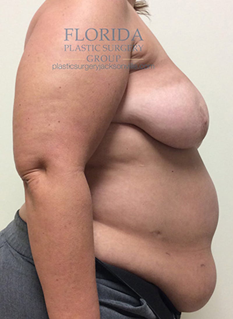 DIEP Flap Reconstruction Before & After Gallery - Patient 154952303 - Image 9