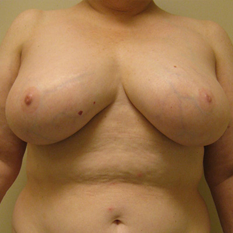 Breast Reduction Before & After Gallery - Patient 154952305 - Image 1