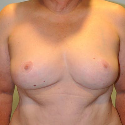 Breast Reduction Before & After Gallery - Patient 154952305 - Image 2