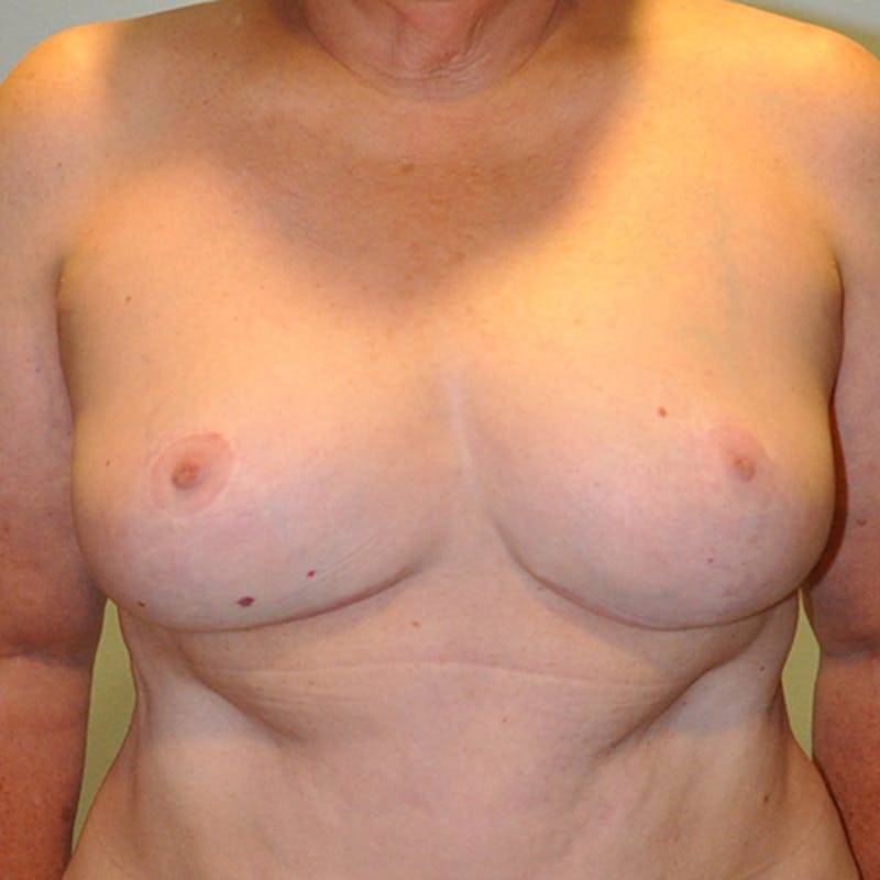 Breast Reduction Before & After Gallery - Patient 154952305 - Image 2