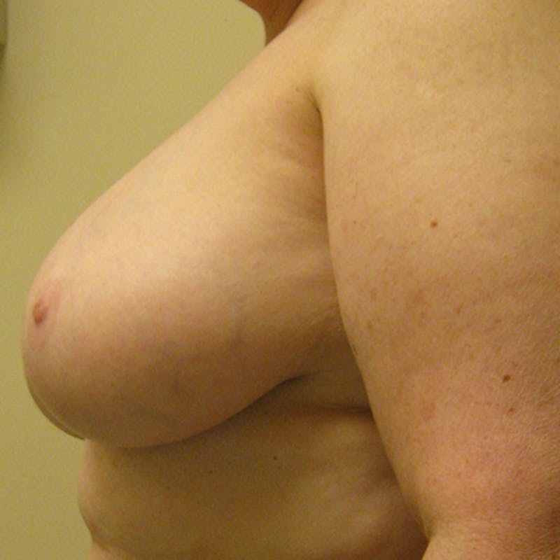 Breast Reduction Before & After Gallery - Patient 154952305 - Image 3