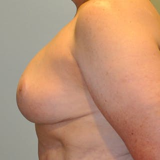 Breast Reduction Before & After Gallery - Patient 154952305 - Image 4