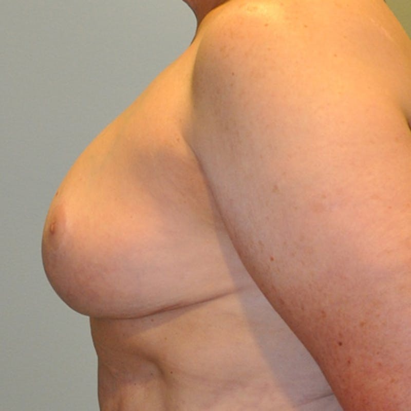 Breast Reduction Before & After Gallery - Patient 154952305 - Image 4