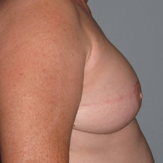 Tissue Expander Reconstruction Before & After Gallery - Patient 154952306 - Image 6