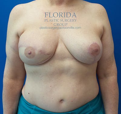 DIEP Flap Reconstruction Before & After Gallery - Patient 154952310 - Image 2