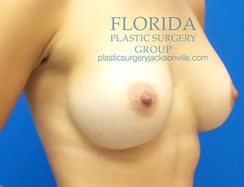 Revision Breast Surgery Before & After Gallery - Patient 154952312 - Image 3