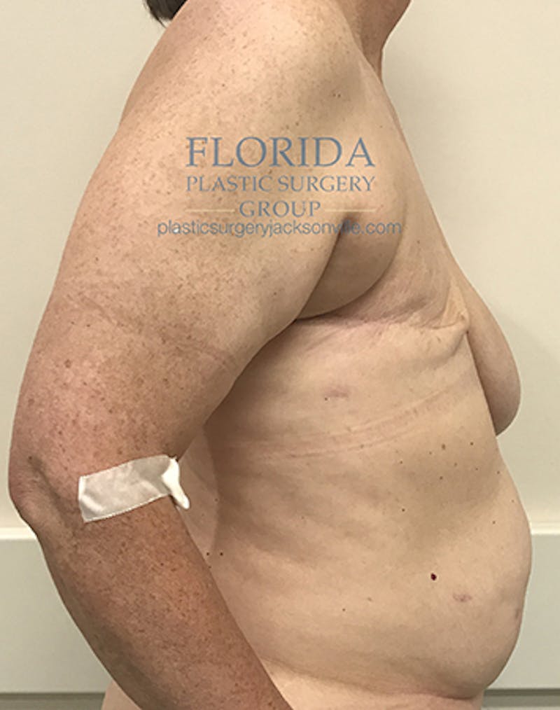 DIEP Flap Reconstruction Before & After Gallery - Patient 154952310 - Image 3