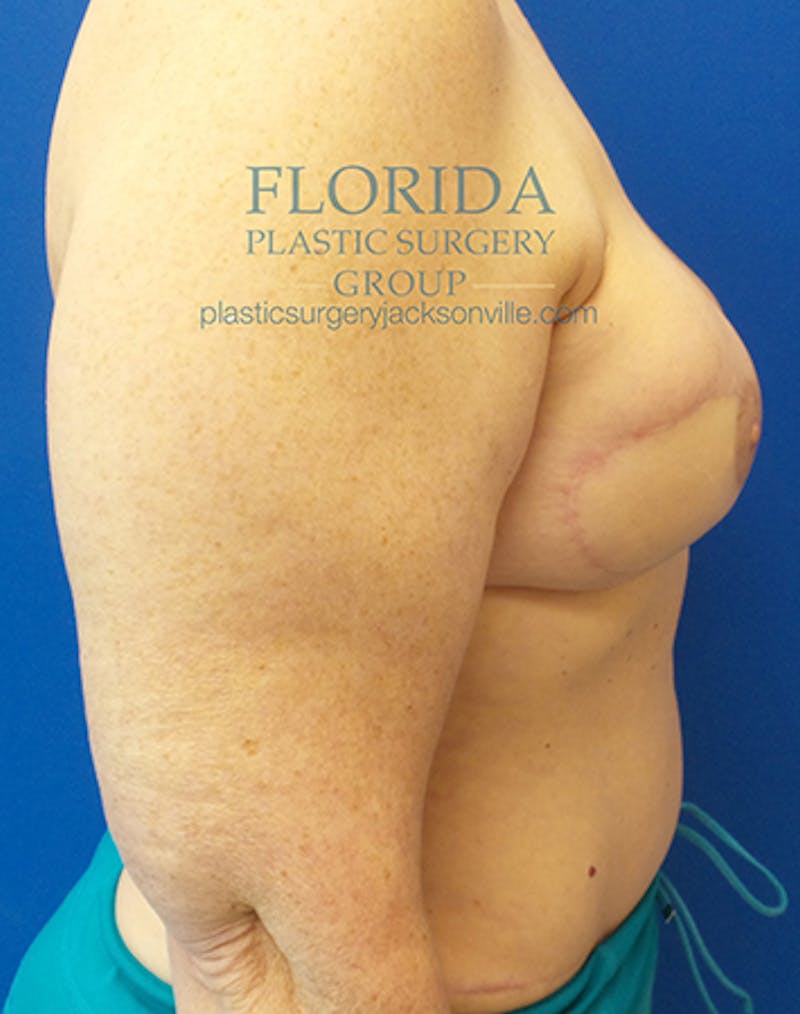 DIEP Flap Reconstruction Before & After Gallery - Patient 154952310 - Image 4