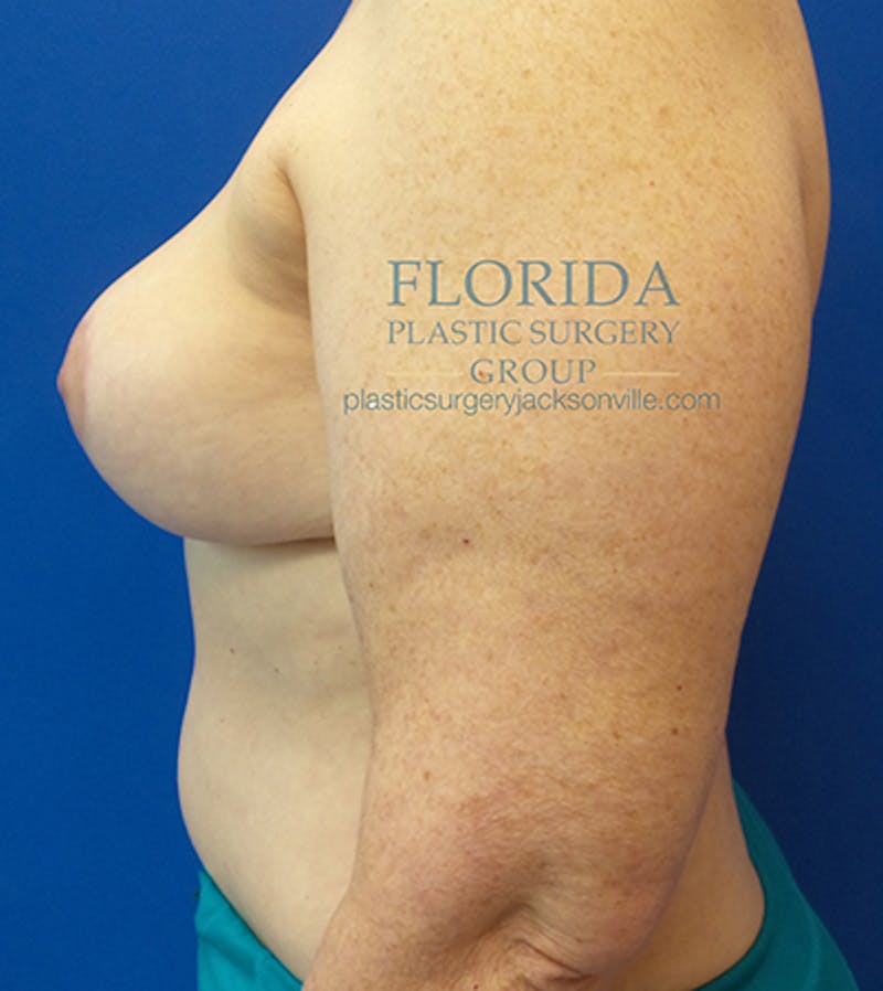 DIEP Flap Reconstruction Before & After Gallery - Patient 154952310 - Image 6