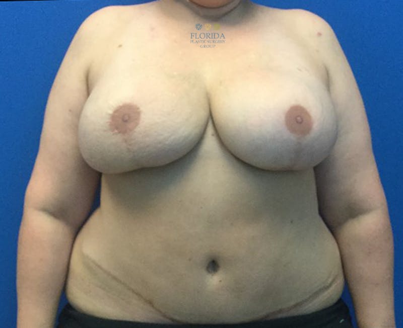 DIEP Flap Reconstruction Before & After Gallery - Patient 154952315 - Image 2