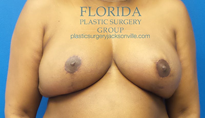 Breast Reduction Before & After Gallery - Patient 154952319 - Image 2