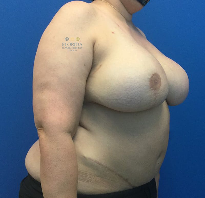 DIEP Flap Reconstruction Before & After Gallery - Patient 154952315 - Image 4