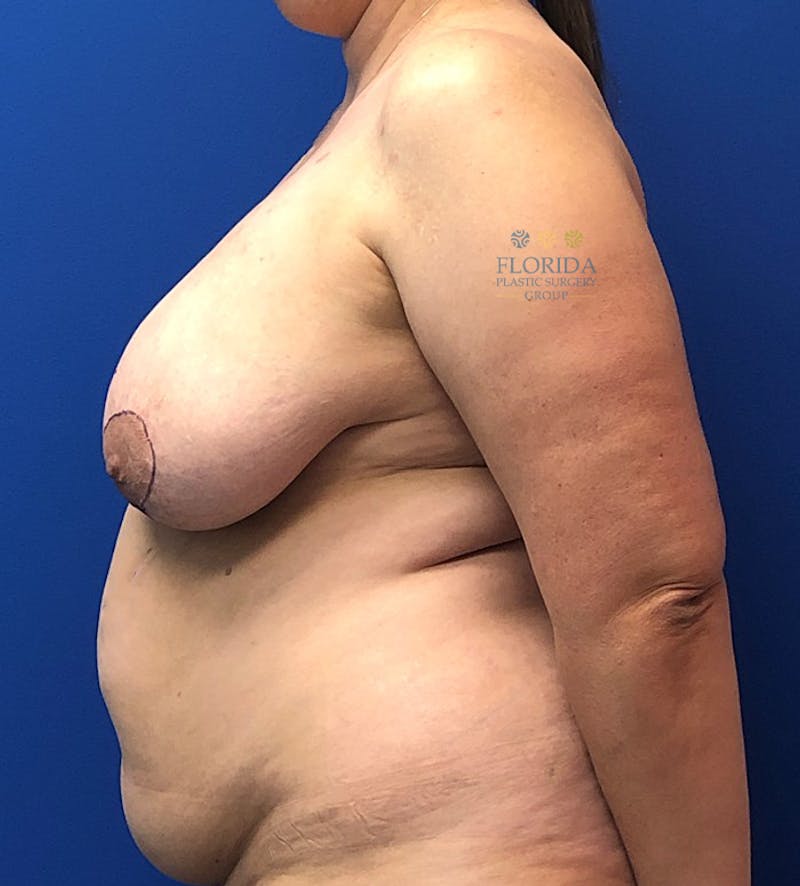 DIEP Flap Reconstruction Before & After Gallery - Patient 154952315 - Image 5