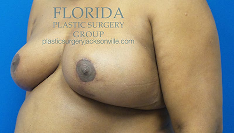 Breast Reduction Before & After Gallery - Patient 154952319 - Image 8
